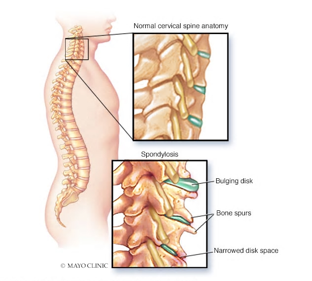 Cervical spondylosis