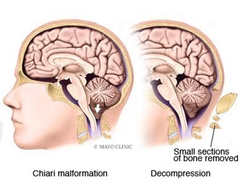 Chiari malformation