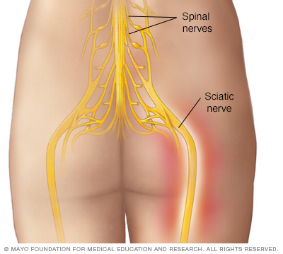 Sciatica