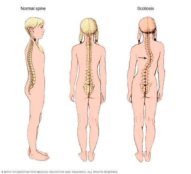 Scoliosis