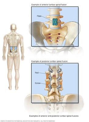 Spinal Fusion, Lower Back