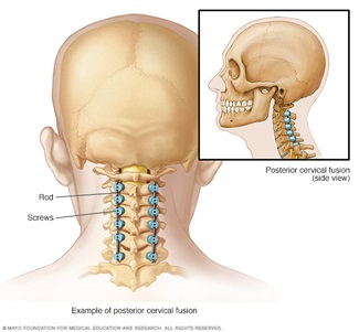 Spinal Fusion Neck