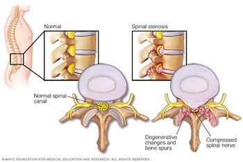Spinal Stenosis