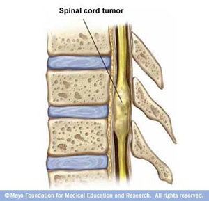 Spinal tumor