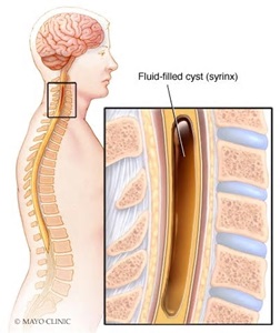 Syringomyelia