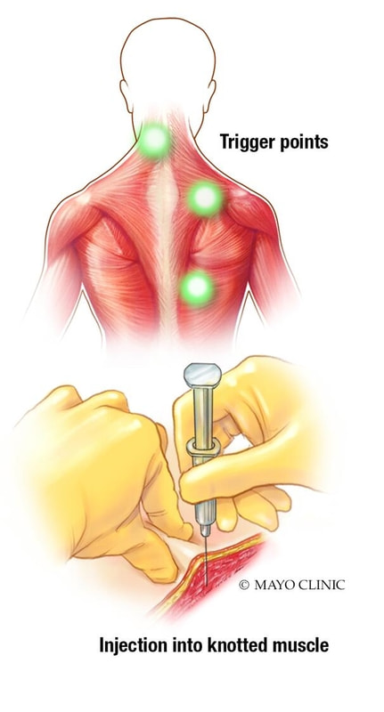 Trigger point injection illustration